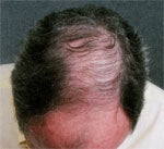 Hair Transplant before 426683