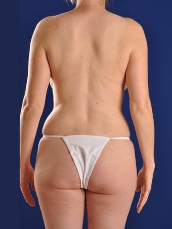 Vaser Hi Def Liposuction of abdomen, thighs, flanks and back with fat injections to buttocks before 422680
