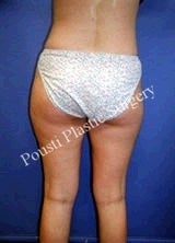 Liposuction 634648