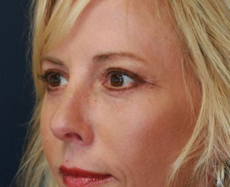 Upper and Lower Eyelids after 269094