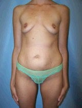 Tummy Tuck (Abdominoplasty), Breast Enhancement, Mommy Makeover before 428724