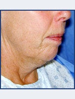 Neck Lift and Chin Implant before 87077