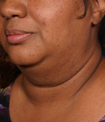 Neck liposuction with thermage before 137999