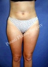 Liposuction before 634648