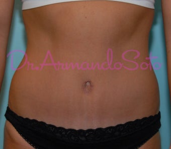 Abdominoplasty (Tummy Tuck) after 225070