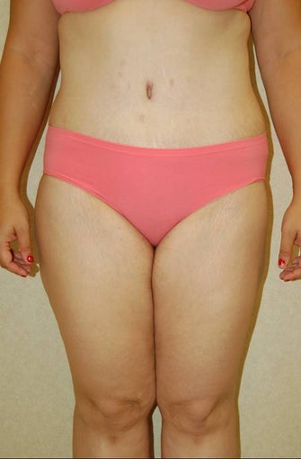 body lift after 258897