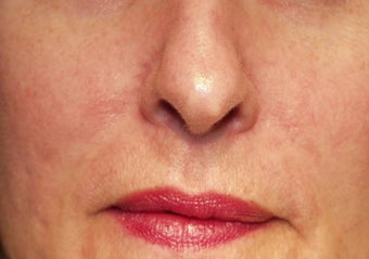 Vein treatment after 135899