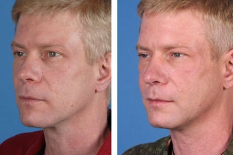 Radiesse, Restylane, Juvederm Plus & Botox Cosmetic after 356492