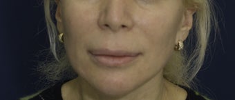 Lip Lift before 606645