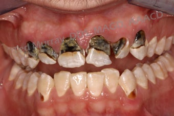 Direct Composite Resin Veneers 346958