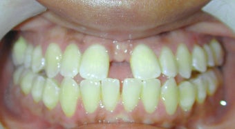Adult Orthodontic Treatment (case #3KE) before 224691