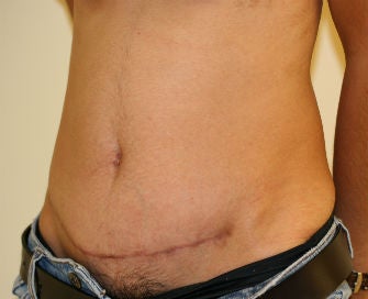 Abdominoplasty Revision 493649