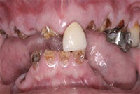 Dental Implants before 510573