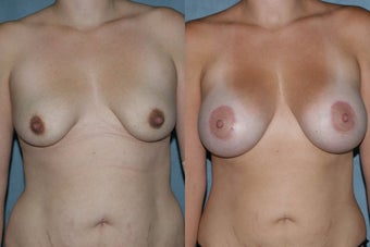 Breast Augmentation - Silicone Implants before 130838