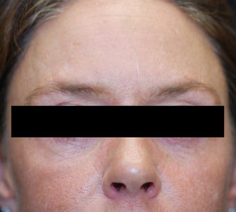 Dysport in the horizontal forehead lines. after 624794