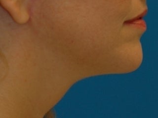 Lower Facelift with Submental Liposuction (Liposuction under the chin) after 243863