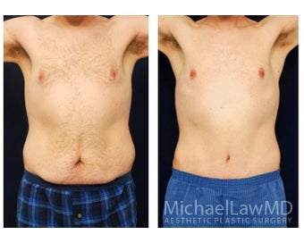 Abdominoplasty - Tummy Tuck before 396130