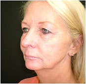 Facelift, Endoscopic Forehead Lift, Quadrilateral Blepharoplasty before 205368
