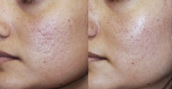 Acne scar before 182792