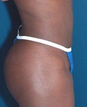 Tummy Tuck after 634166