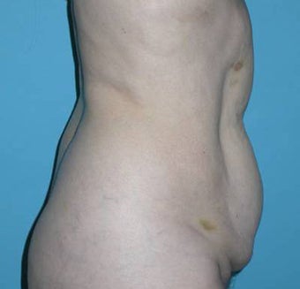 Tummy tuck before 111941