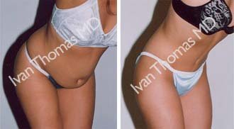 Tummy Tuck before 242535