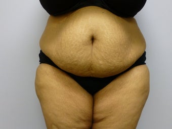 Mini Tummy Tuck and liposuction before 590774