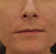 Acne Scarring after 426028