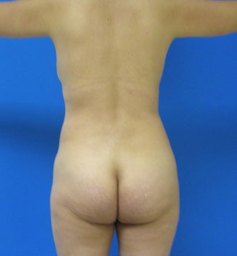 Brazilian Butt Lift before 367398
