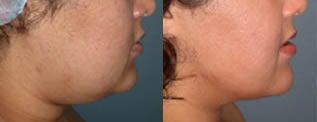 Liposuction (chin and jaw line) before 96477