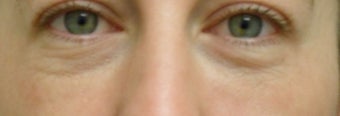 Under eye bag treatment before 151901