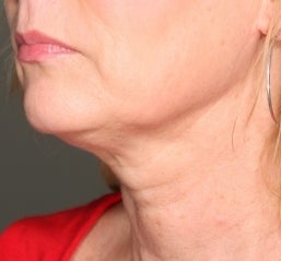 Ultherapy 582605