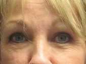 Brow Lift before 541495