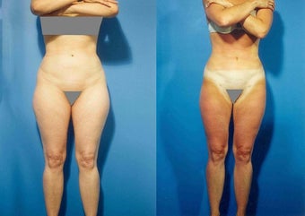 Liposuction before 636175