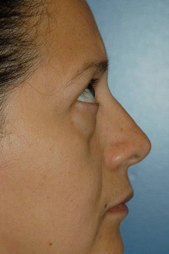 Upper and lower lid blepharoplasty and Fat Transfer to lower lids and midface 307125