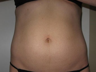 Lipotherme before 272091