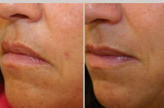 Restylane before 311742