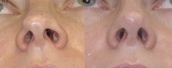 Revision Rhinoplasty before 548871