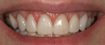 Gum re contouring after 393308