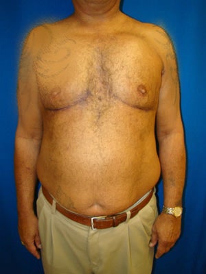 Pectus Excavatum, Chest Wall Reconstruction Surgery after 145941
