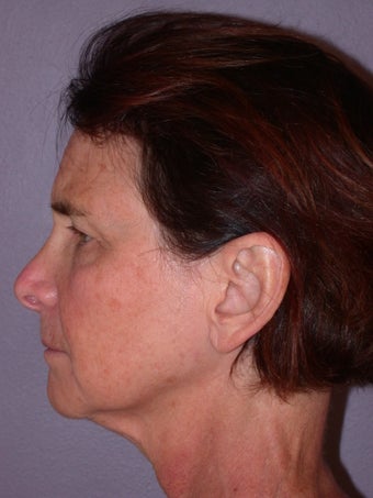 Neck lift before 306413