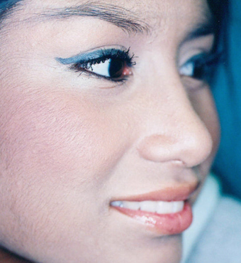 Rhinoplasty after 263624
