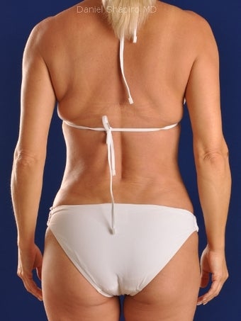 Vaser Hi-Def Liposuction of abdomen, chest, back and flanks after 422714