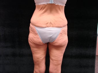 Body Lift with Liposuction of Abdomen, Waist, and Flanks before 203471