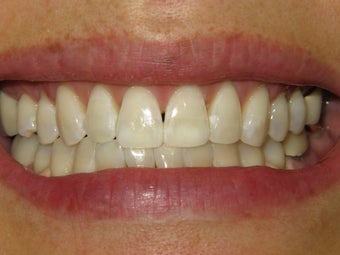 KOR Whitening after 307309