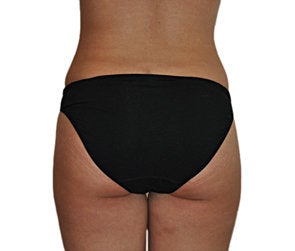 Butt Augmentation (Implants) after 550251
