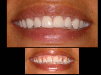 Porcelain veneers to close gaps before 119941