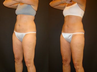 CoolSculpting before 576273