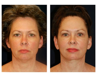 Facial Rejuvenation before 374118