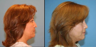 Revision Rhinoplasty before 433795